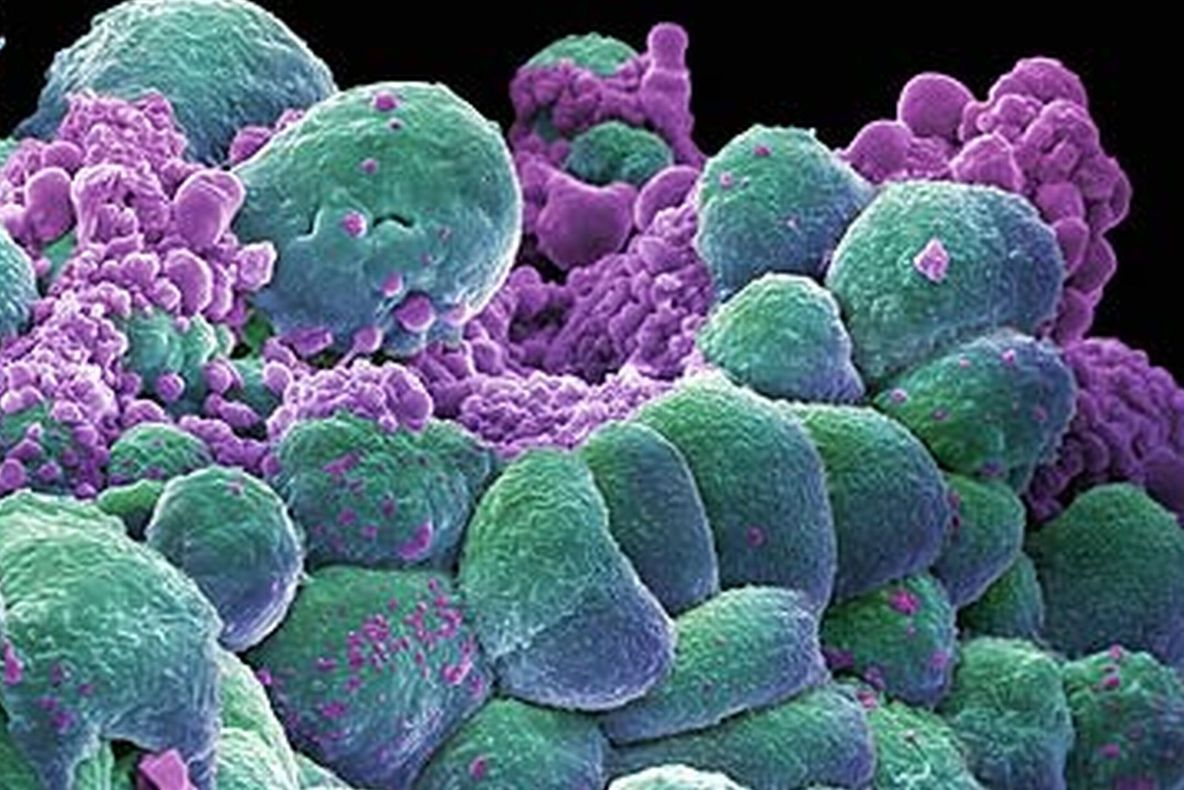 Studiu revoluționar. Cancerul poate fi depistat printr-o simplă analiză, cu mult înainte să evolueze