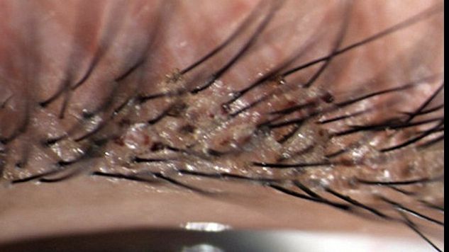 Fetița de 4 ani se plângea de mâncărimi la ochi. Medicii, îngroziți când au văzut ce trăia acolo