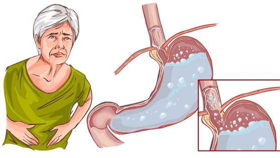 Cum să folosești corect bicarbonatul de sodiu pentru problemele cu stomacul