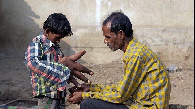Drama băiatului cu mâini gigantice. I se spune "copilul diavolului"