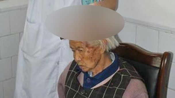 E poreclită ”femeia-unicorn”. Cum arată bătrâna căreia i-a crescut o aluniță uriașă în frunte