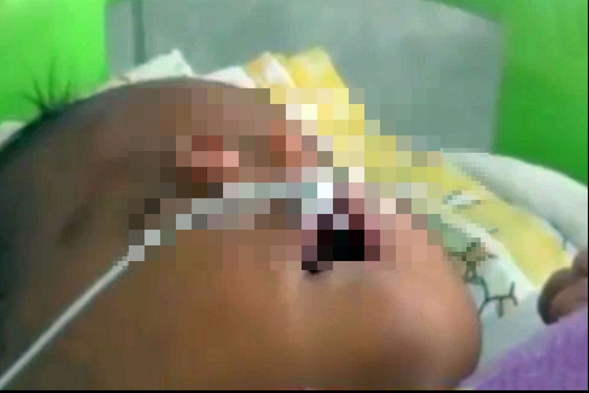 Cum arată bebelușul care s-a născut cu două nasuri? Medicii au rămas șocați