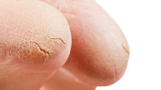 Soluția-minune care te scapă de călcâiele uscate și crăpate