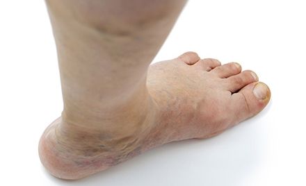 FRESH REFRESH! Cât de grav este să ai picioarele supraponderale