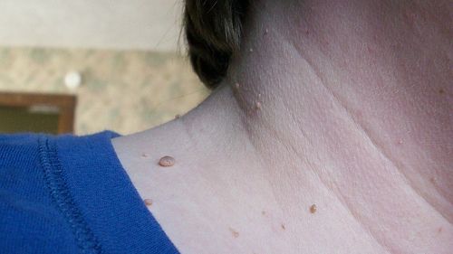 Ce sunt papiloamele, cât de periculoase sunt și cum pot fi îndepărtate