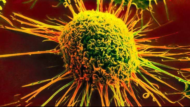 Au mâncat acest fruct timp de doar câteva zile. Celulele canceroase au fost distruse complet