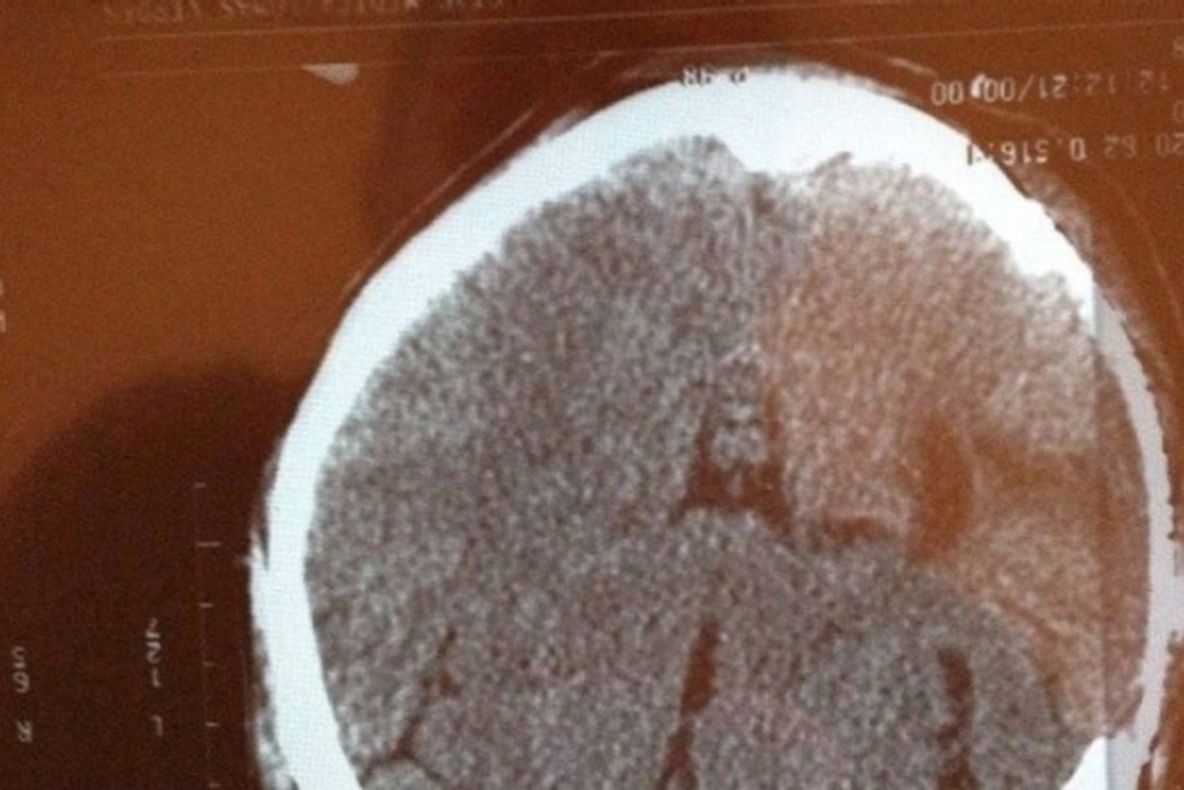 Premieră mondială în medicină. Iată cum a fost operat acest bolnav de cancer