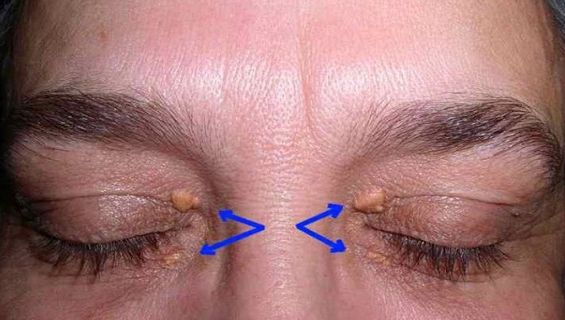 Descoperire alarmantă. Semnul de pe piele care arată că poți face atac de cord