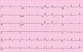 Super veste! Brotac Medical Center are grijă de inima ta! Îți oferă gratuit electrocardiograma!