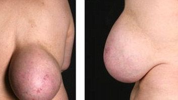 Povestea emoţionantă a femeii cu un sân pe spate. Medicii s-au îngrozit când au văzut-o