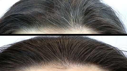 Medicilor nu le-a venit să creadă. Amestecul care face ca firele albe de păr să se ”coloreze” înapoi