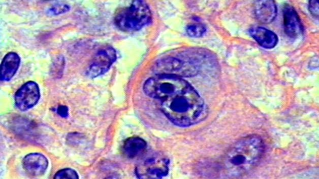 Forma gravă de cancer care nu se depistează la analize. Medicii îl confundă cu o infecție