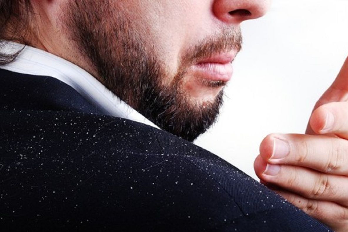 Aşa poţi să scapi de mătreaţa abundentă. Cele mai bune remedii