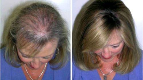 E nevoie de un singur ingredient ca să opreşti căderea părului. Firele vor creşte din nou