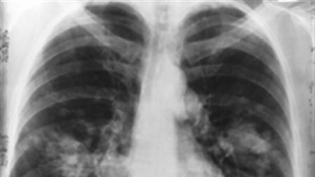 Toți fumătorii trebuie să știe asta. Cel mai bun remediu natural pentru curățarea plămânilor