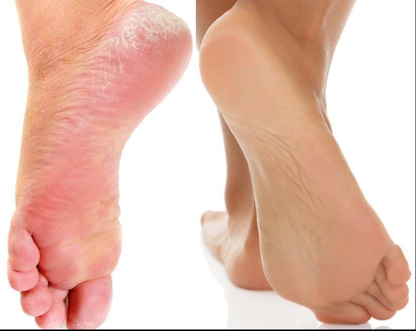 Scapă de călcâiele crăpate cu un ingredient chiar la tine acasă