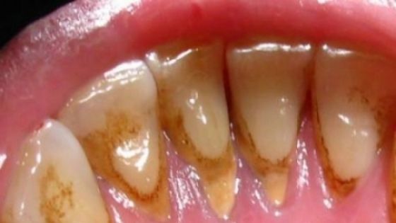 Cea mai eficientă metodă de îndepărtare a tartrului. Nu mai ai nevoie de dentist