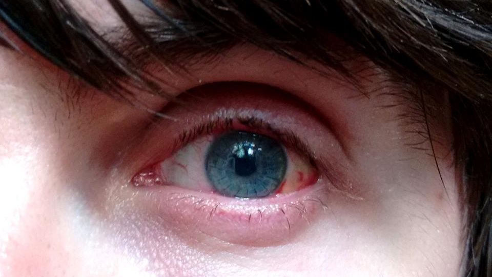 Operaţie inedită la Iaşi: medicii au făcut un transplant de cornee de la un pacient viu