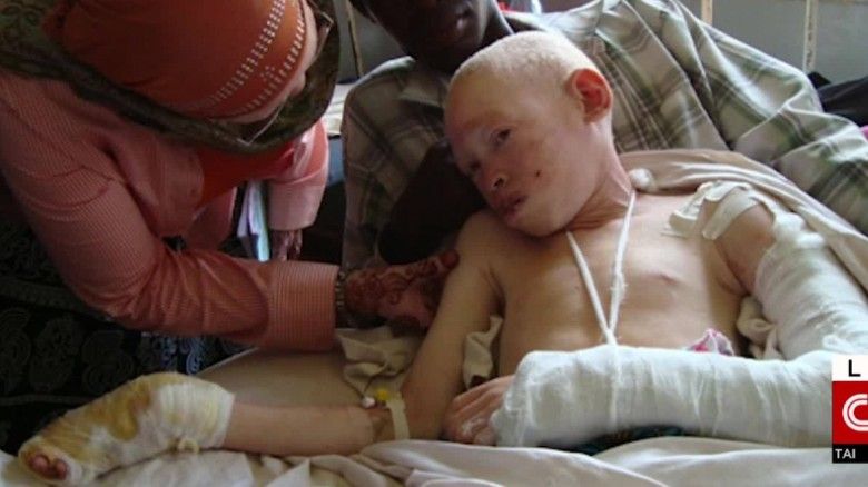 Superstiţie barbară: au crezut că are oase fermecate şi i-au tăiat degetele de la mână 