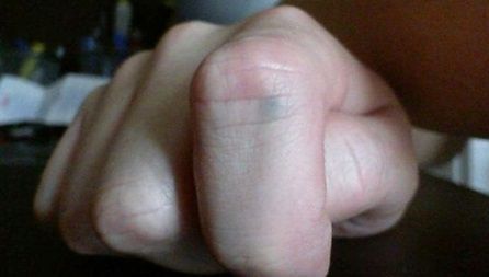 De 13 ani avea un semn gri pe deget! Îngrijorat, a decis să meargă la doctor. Incredibil ce a aflat