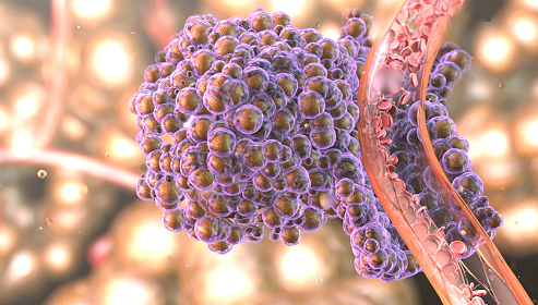 Care sunt cele trei alimente care duc la apariția cancerului. Le mâncăm zilnic 