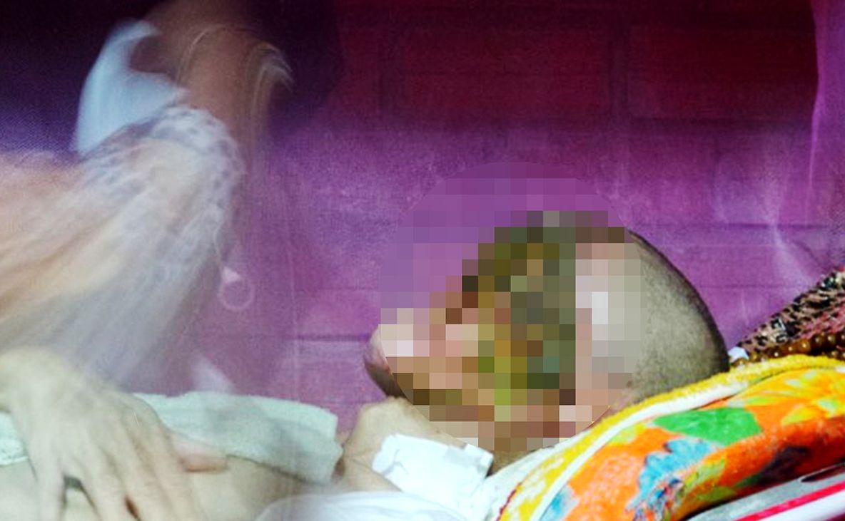 Halucinant! Un virus i-a mâncat aproape toată fața. Victima abia poate vorbi