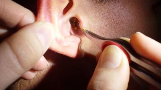 Simțea o mișcare și auzea zgomote ciudate în ureche. Medicii au înghețat când au cercetat cauza