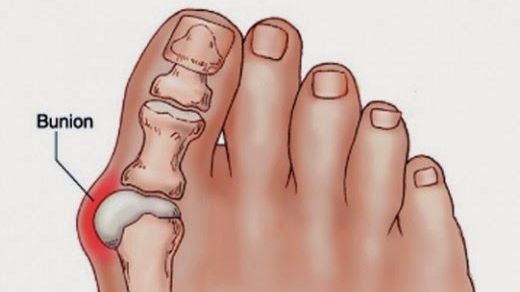 Rezultate incredibile. Soluţia ieftină care te vindecă de monturi în 14 zile, fără operaţie