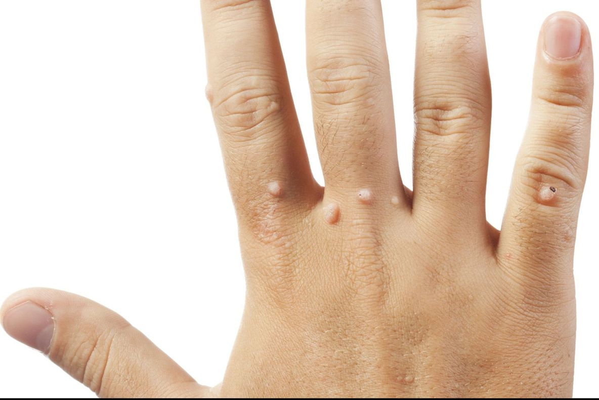 Scapă de negi cu coji de banane. Iată cum trebuie folosite. Efectele se văd imediat