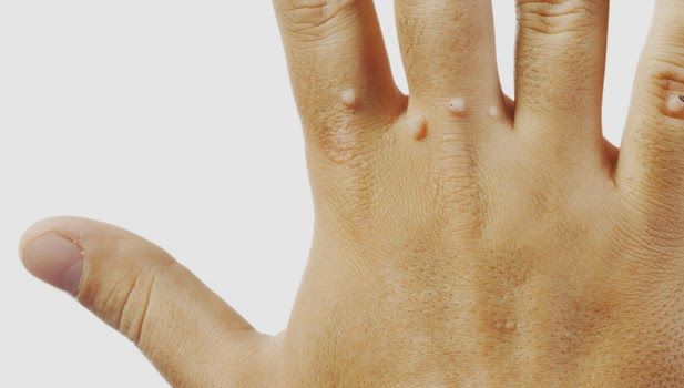 Cea mai bună metodă prin care poţi scăpa de negi. În două săptămâni pur şi simplu dispar