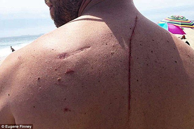 Atacul înfiorător al unui rechin i-a salvat viața. Medicii nu știau ce să mai creadă