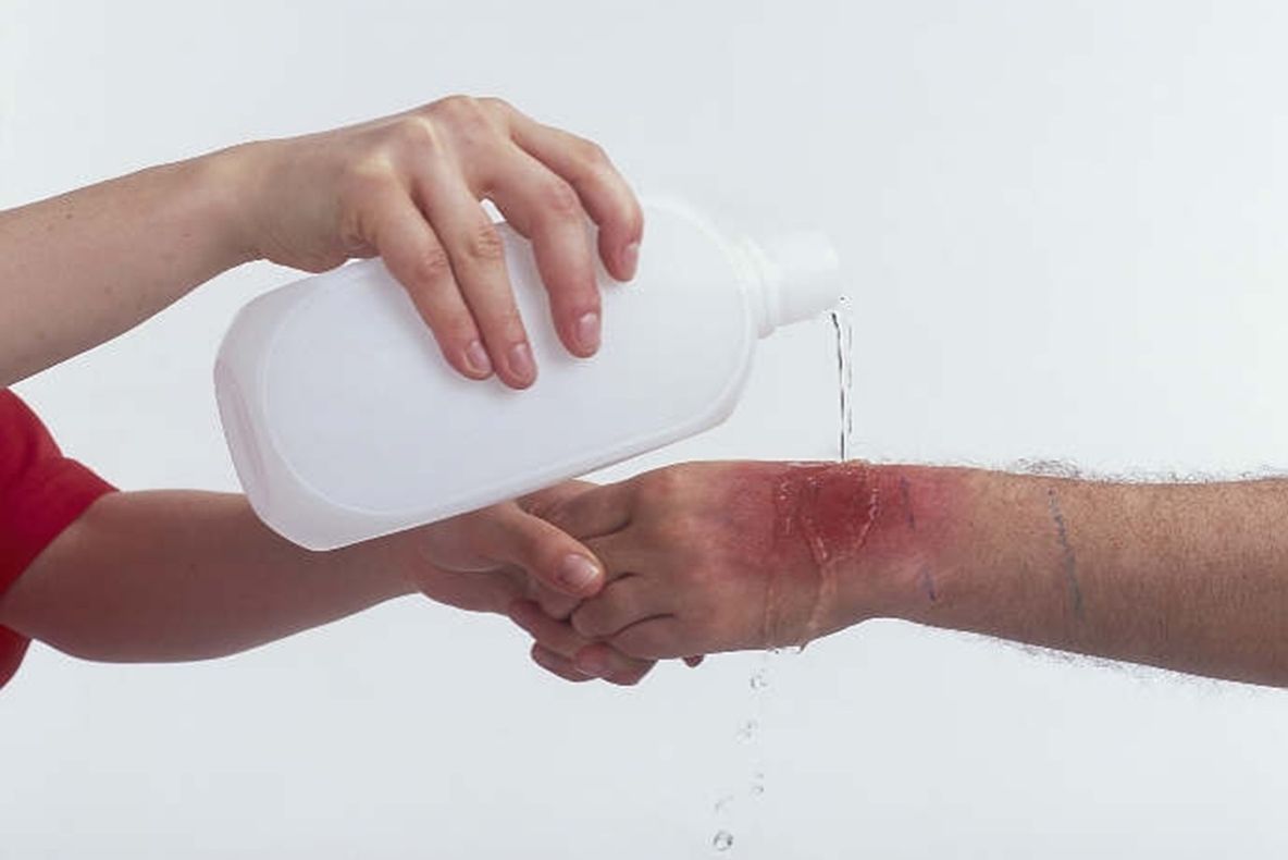 Remediul miraculos pentru arsurile de piele. Vindecă în profunzime și pe tegument