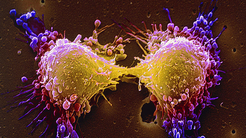 De ce recidivează cancerul după ce "te vindeci"?