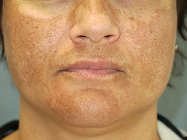 Exclusiv! Cum tratezi Melasma, plăcile pigmentare de pe față