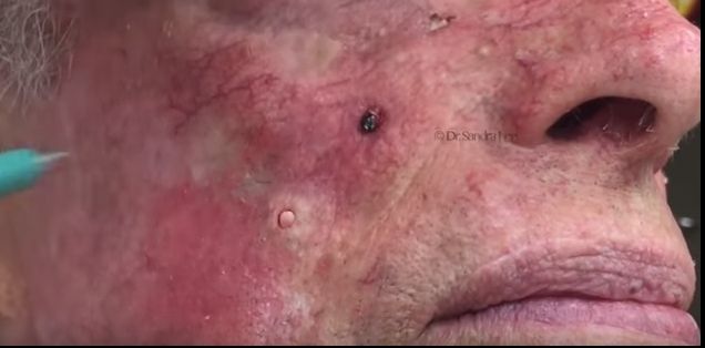 I-a stors punctul alb de pe obraz, dar a înmărmurit când a văzut ce monstru a scos. ”E cât o râmă”