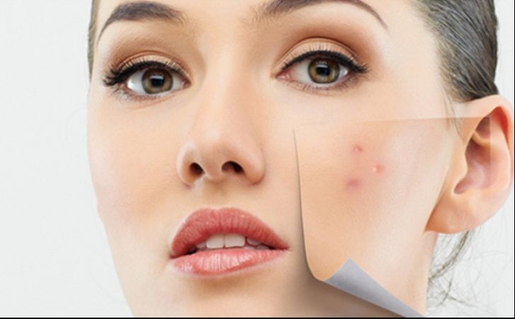 Crema-minune care te scapă de acnee în doar 3 zile. Cum s-o prepari acasă