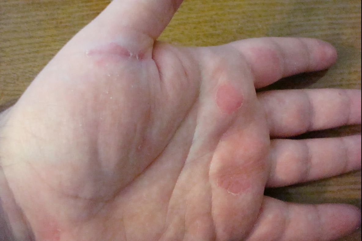 Primul semn de cancer apare pe mâini. NU îl ignora!