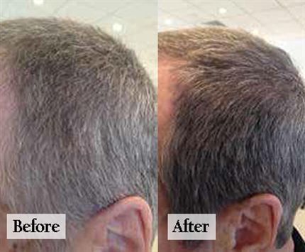 Descoperă metoda revoluționară care te scapă de părul cărunt! (P)