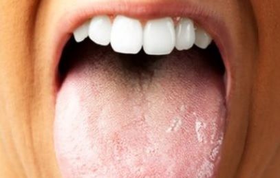 Ai limba crăpată la vârf? Mergi URGENT la medic! E vorba despre o boală cumplită!