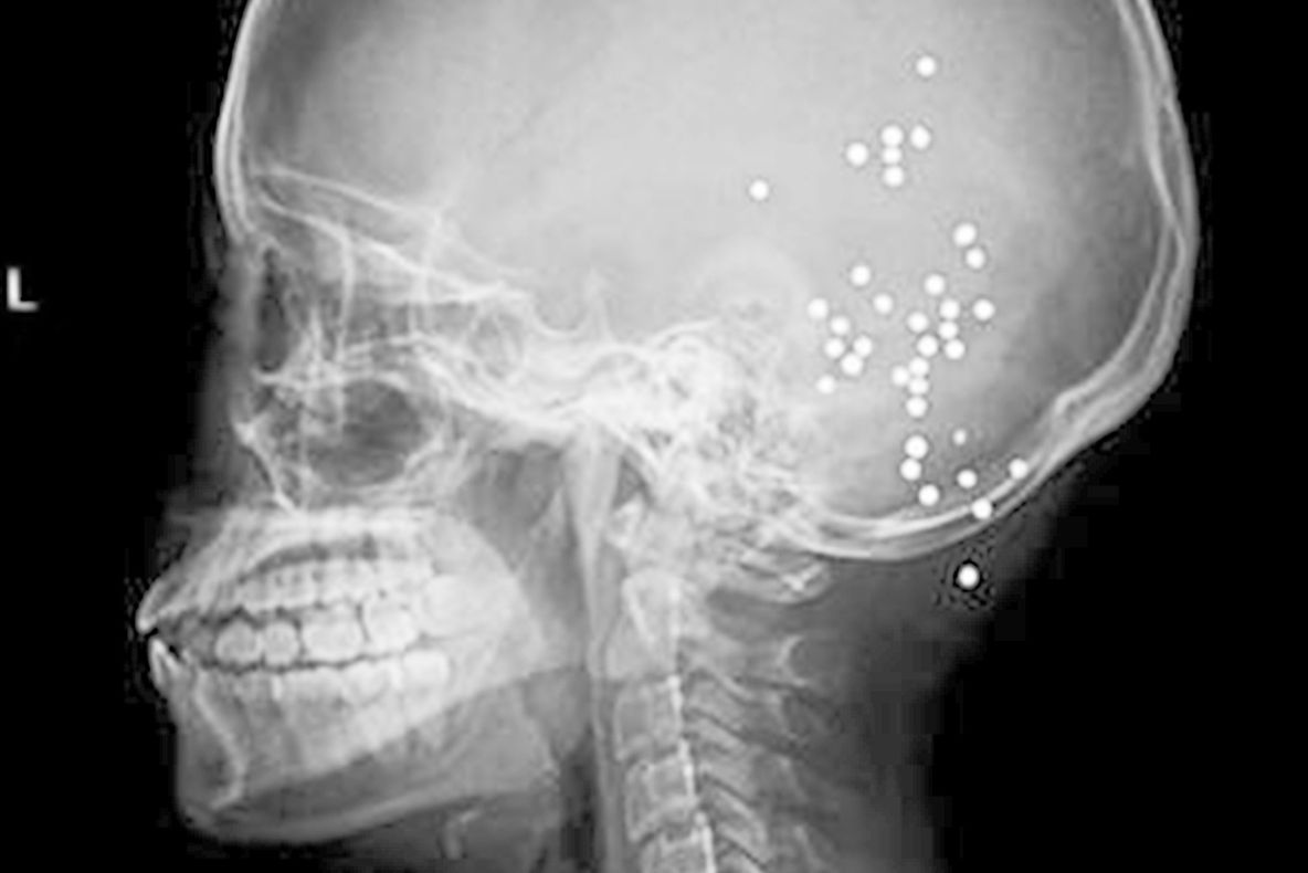 Când au văzut această radiografie, medicii au încremenit. Ce păţise pacienta