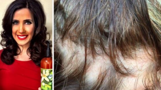 Şi-au pierdut părul din cauza unui şampon intens promovat