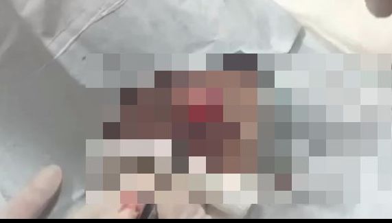 A tăiat umflătura de pe piciorul unui pacient. A împietrit de ceea ce a găsit acolo:”Parcă e o nucă”