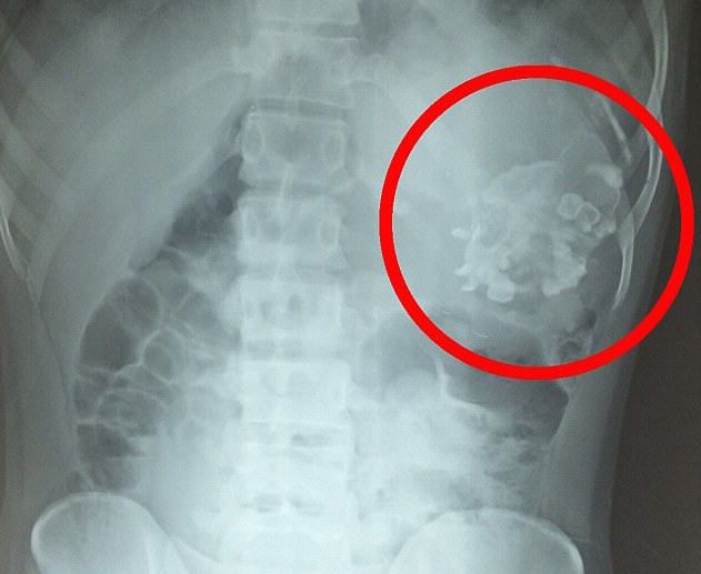 A ajuns la spital cu dureri groaznice de stomac. Ce i-au găsit în el este de nedescris