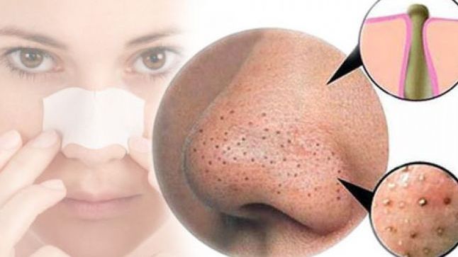 Cum să scapi de punctele negre. Definitiv