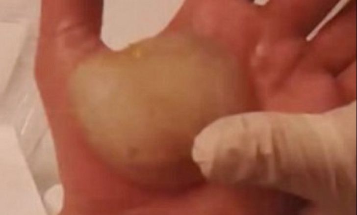 I-a ieșit o bășică imensă în palmă după ce s-a ars. A înțepat-o cu acul! A înmărmurit de ce a ieșit