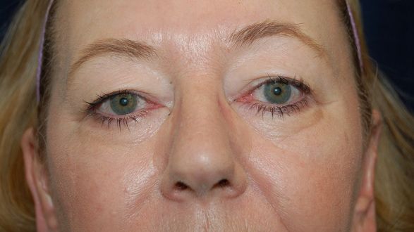 Scapă definitiv de cearcăne şi pungile de sub ochi cu un ingredient pe care şi tu îl ai în casă