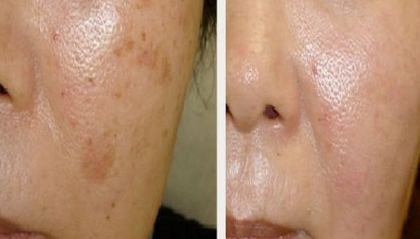 Cele mai eficiente remedii de înlăturare a petelor închise de pe ten. Pentru totdeauna