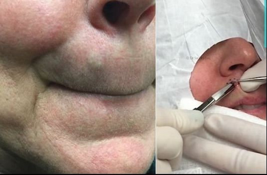 Avea o umflatura deasupra buzei și a stors-o. S-a frecat la ochi: nu-i venea să creadă ce iese 