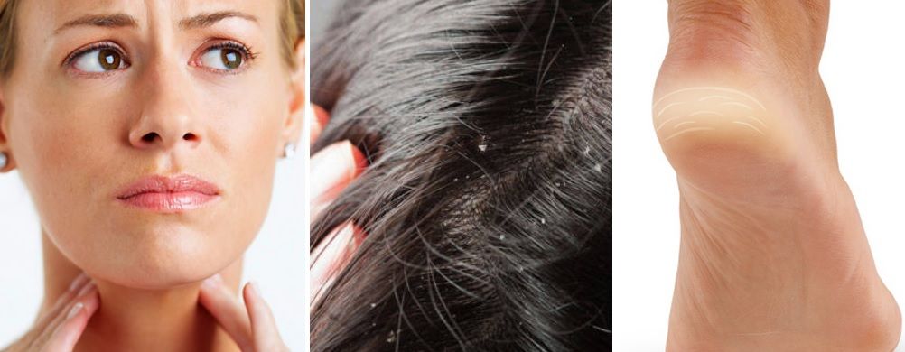 Un singur ingredient vindecă roșul în gât, te scapă de mătreață și de călcâie crăpate