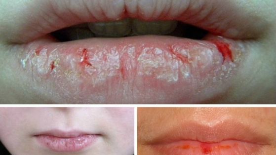 Spune ADIO buzelor crăpate și uscate în sezonul rece! 7 remedii simple, la îndemâna oricui 